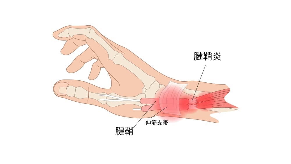 ばね指を自分で治すストレッチ方法3選 画像付きで解説リペアセルクリニック東京院