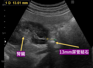ようやく拝石した尿管結石の写真素材74003801- PIXTA