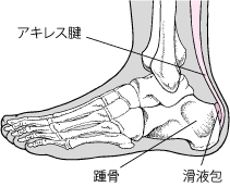 アキレス腱滑液包炎・ハグルンド病