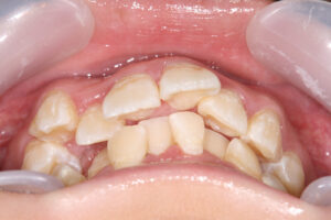 ビーバー歯は矯正できる？原因・治療法・費用まで徹底解説！マウスピース矯正・歯列矯正ブログ