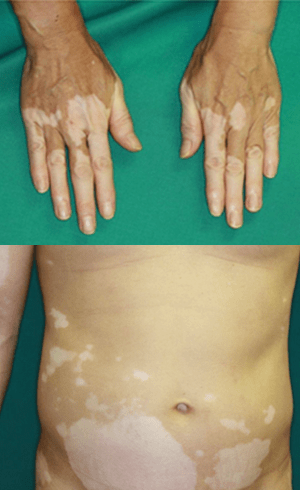 しみ・肝斑・そばかすの症例写真美容皮膚科 銀座よしえクリニック 公式 東京