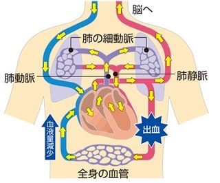 脳出血・くも膜下出血循環器情報サイトAssist