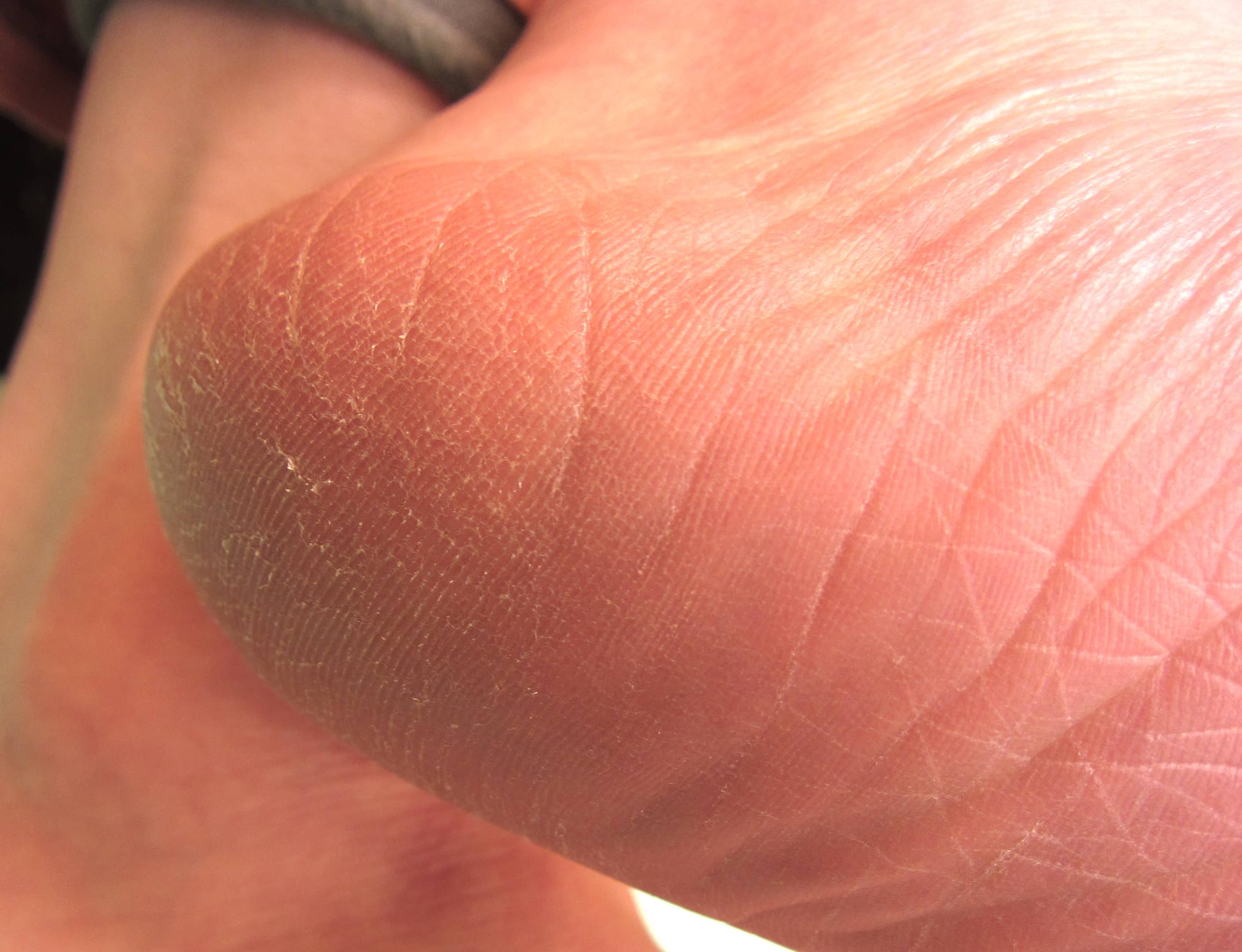 皮膚に白い皮むけ野田市 小児科 千葉県 こどもの花粉症 こどもの漢方 喘息 アトピー性皮膚炎 アレルギー 結節性痒疹 たんぽぽこどもクリニック