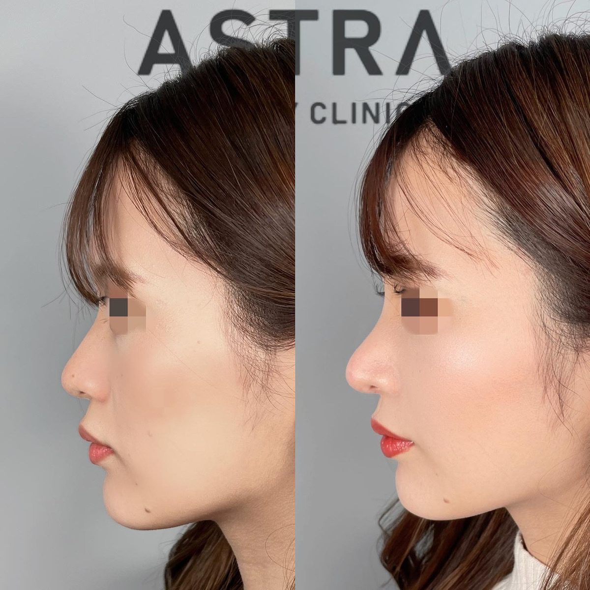 横顔は意外と見られています！！〜顎編〜グランヴォーテ