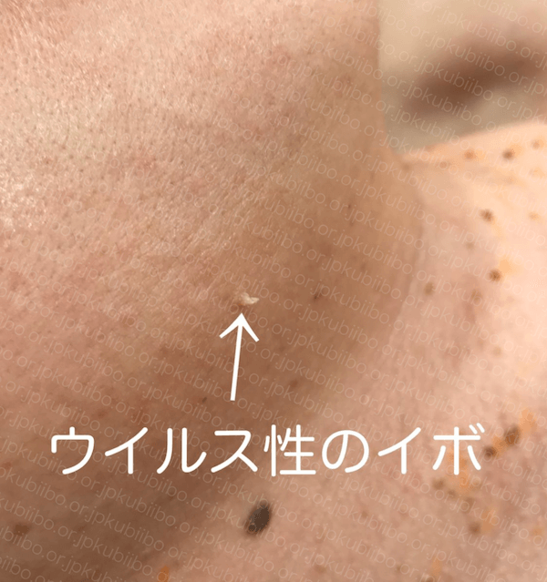 首イボはなぜできる？原因と治療法を医師が解説 - 首イボDr