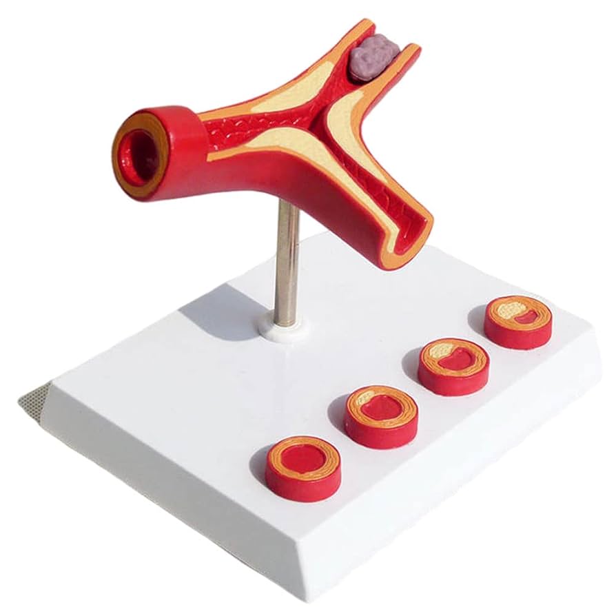 アテローム性動脈硬化症」の1.7万点のロイヤリティフリー画像、写真素材、絵Shutterstock