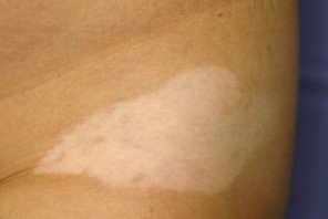 認識できない手の男性の白斑は、皮膚に白い斑点のある顔の一部です 皮膚病を持つ人々は、他の人と同じように生きています幸せな人生のためには、自然な体を受け入れることが必要ですPremium写真