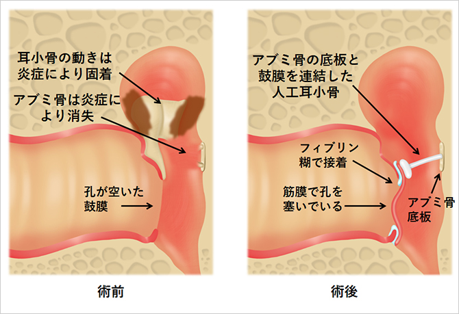 耳の手術徳島 大櫛耳鼻咽喉科 はな・みみサージクリニック