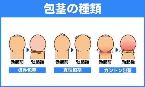 真性包茎はヤバい！？悩める男性のために改善方法を調べました♡