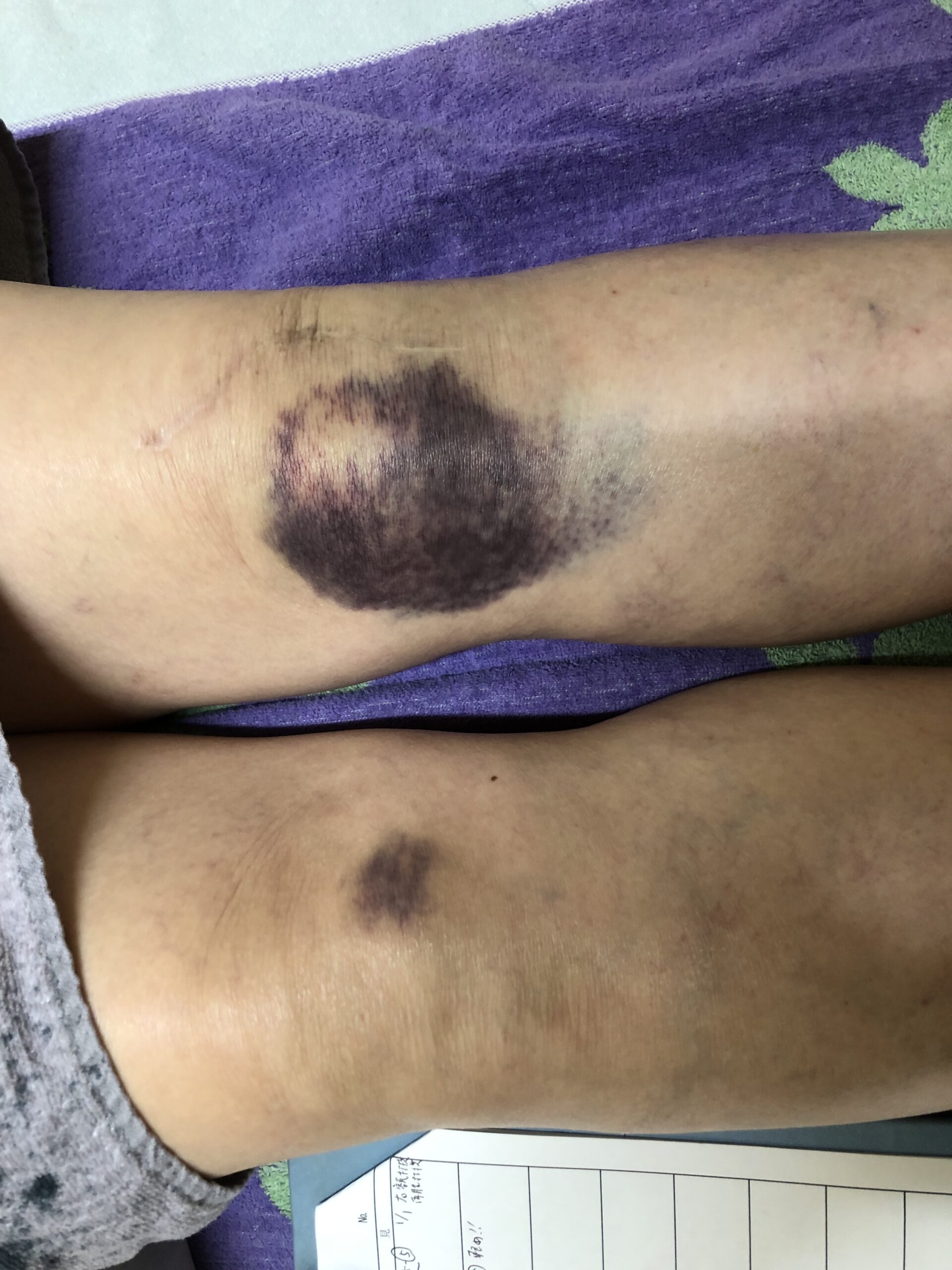 痣 あざ の原因と治療法を解説――できやすい体質や消えないケースも専門医が説明します