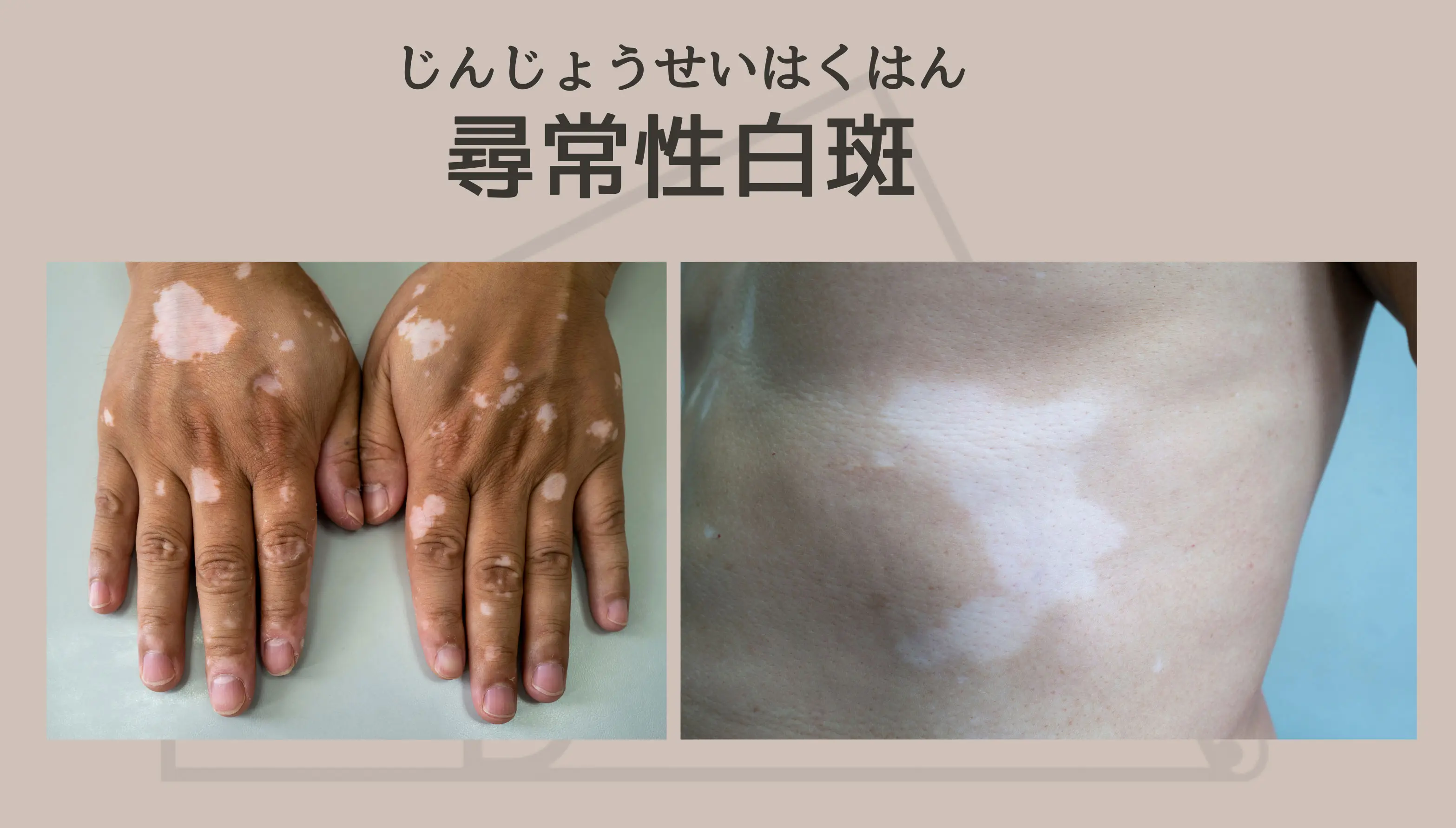 重症尋常性白斑に朗報！本格的な漢方を短期間服用で色素島ができた方続々・東京駅より徒歩２分