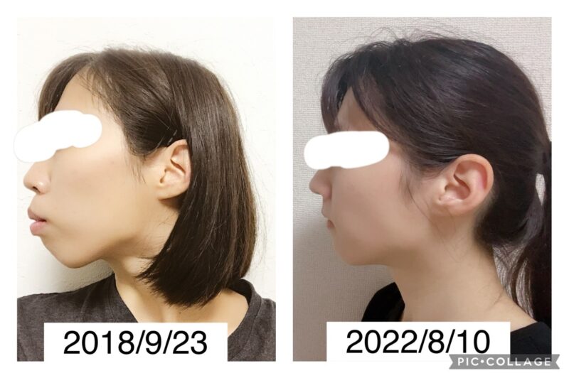 姿勢・呼吸・歯並びの関係 - いけがみ小児歯科 広島県東広島市