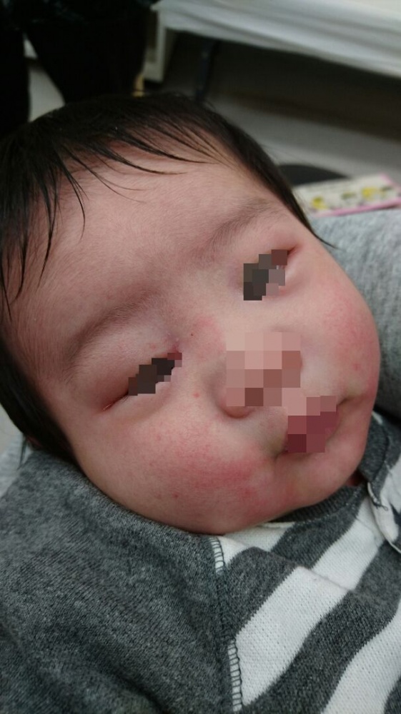 健康コラム 食物アレルギーについてたかさき子育て応援情報サイトちゃいたか