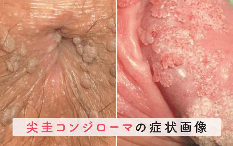 肛門部尖圭コンジローマの症状と原因、治療法 東京都足立区扇大橋・西新井の内科・外科・胃腸内科・整形外科、寺田病院