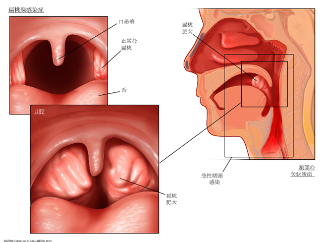 扁桃肥大＆慢性扁桃炎ミルディス小児科耳鼻科
