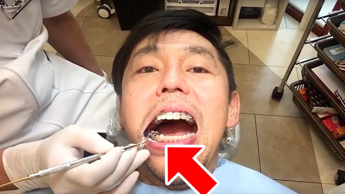 犬歯が当たるので削ったら下あごがズレてしまいました 要注意歯列矯正した40代男のブログ