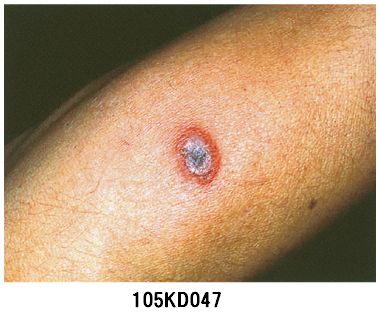 つつが虫病に注意を 草むらに生息のダニ – 宮古新報