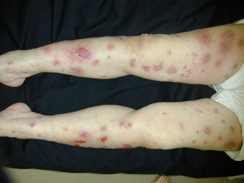 遺伝性皮膚病の原因をDNA解析で解明: 70年間の謎を解き明かし、皮膚病治療に光ハイライト論文名古屋大学 学術研究・産学官連携推進本部