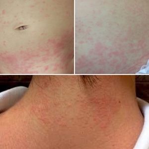 汗疹 あせも や汗かぶれの薬や治し方について 対策・ステロイドひまわり医院 内科・皮膚科