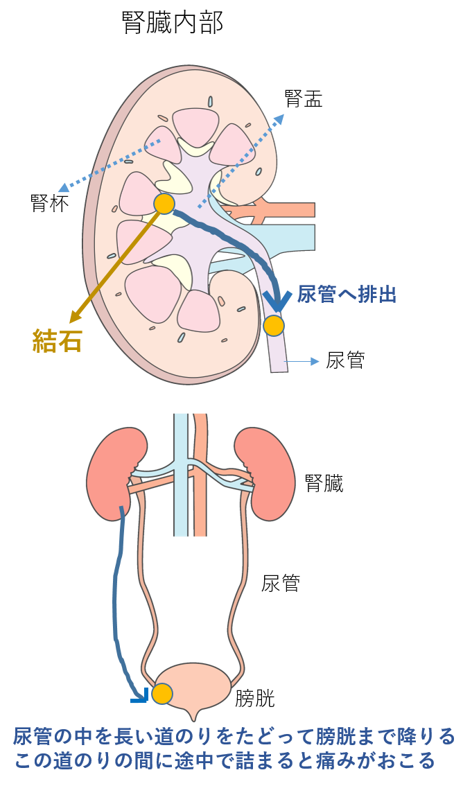 ５分でわかる尿路結石激痛が起きる前に検査まえばる泌尿器科