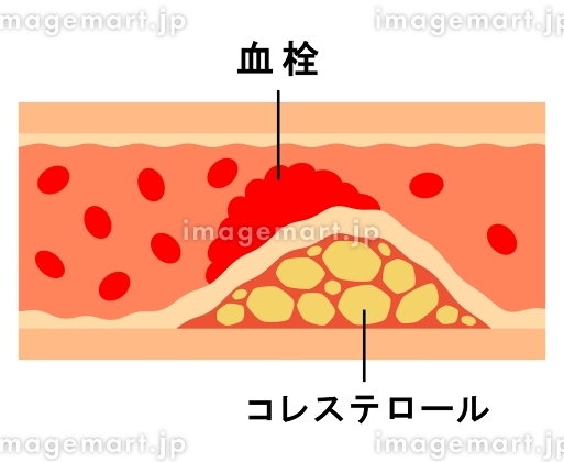 川崎 静脈血栓塞栓症浅田内科・循環器内エコノミークラス症候群
