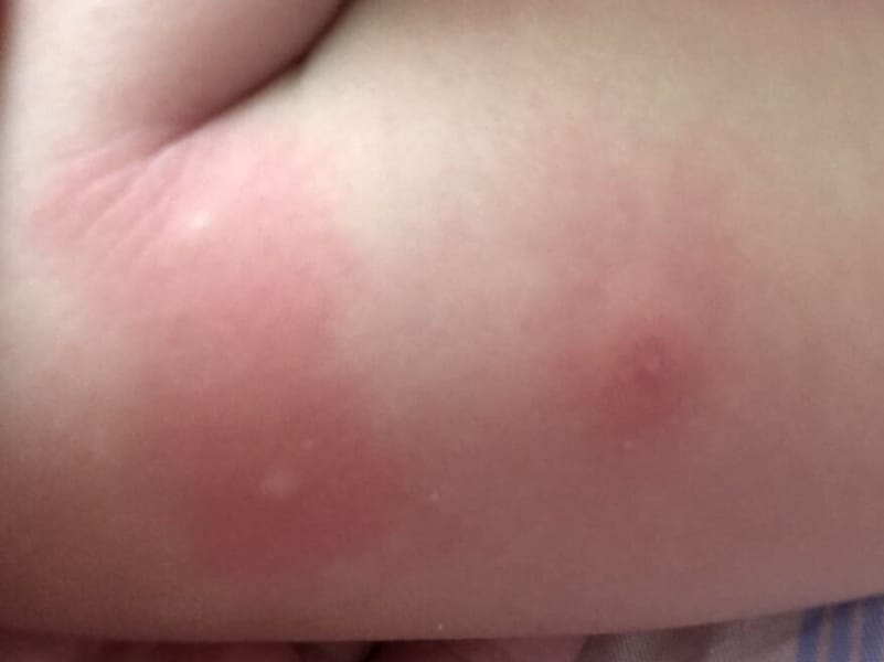 発疹・湿疹など症状写真あり ダニに刺された跡の特徴や症状・対策・あせもとの見分け方 - くらしのマーケットマガジン