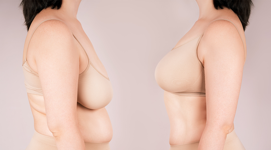 垂れ乳の治し方は何が有効？産後・加齢・巨乳に多いお悩みの原因と解決法