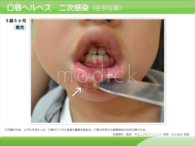 ヘルペス歯肉口内炎 症例写真４歳０ヶ月の男児 の説明スライド - 医療のイラスト・写真・動画、素材販売サイトのメディック medick