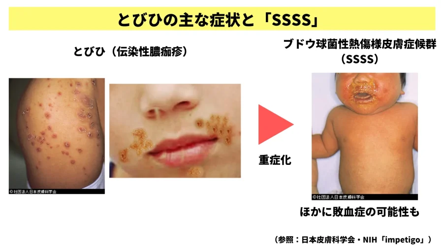 溶連菌感染症感染症ってなに？感染対策コンシェルジュ