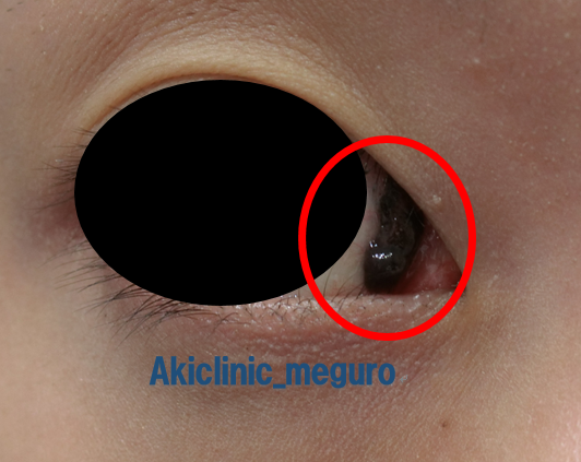 目のまわりのほくろ王子駅の皮膚科シマダ皮膚科クリニック