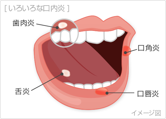 こんな症状が実は病気のサイン？：口腔内の異変と早期発見・治療の重要性口腔がん検診・舌がん検診予約を歯科医院で一般社団法人口腔がん撲滅委員会