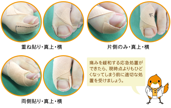 巻き爪テーピングは治る？効果を詳しく解説大田区大森・大木皮膚科