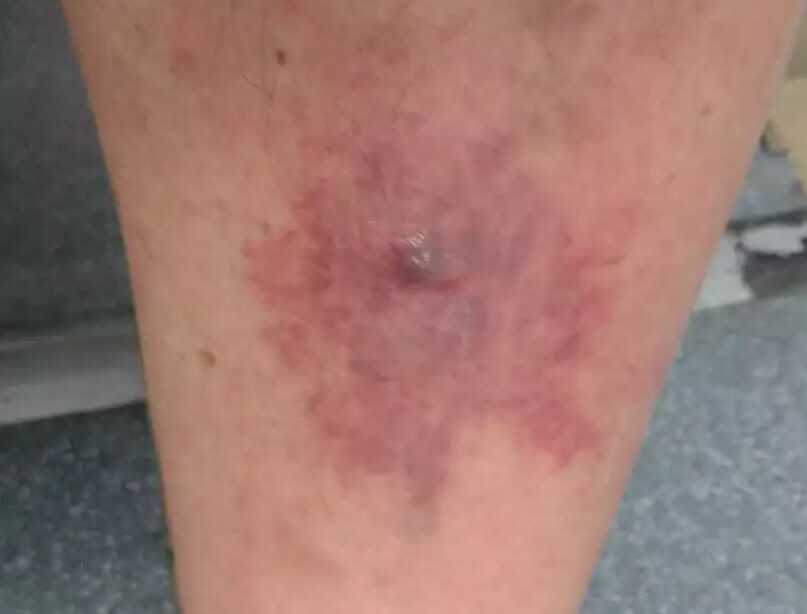 治らない虫刺され ブヨに噛まれ過ぎて死にかけた話。 体験談 焚き火がモグラを呼んでいる