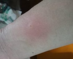 虫刺されによる紫のあざが・原因・治し方は？ イシャチョク