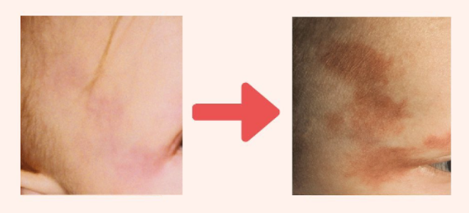 単純性血管腫クリニックひいらぎ皮膚科形成外科池尻大橋・渋谷・三軒茶屋