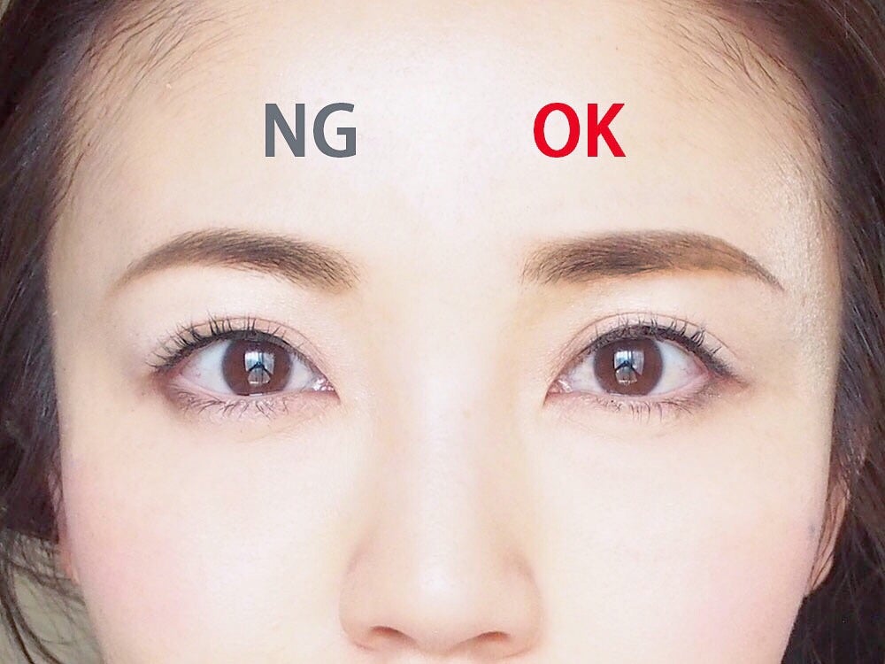 腫れぼったい男性 一重まぶた をスッキリ改善目元 目の上たるみ・目の下クマ 治療形成・美容外科 エムズクリニック 横浜市鶴見