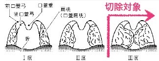 急性扁桃炎の症状や早く治す方法を解説急性咽頭炎との違いは？ - 千葉内科在宅・美容皮膚科クリニック 千葉市稲毛区の内科外来