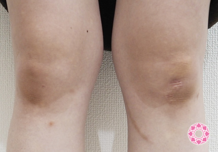 炎症後色素沈着とは前田メディカルクリニック栃木県小山市の美容皮膚科