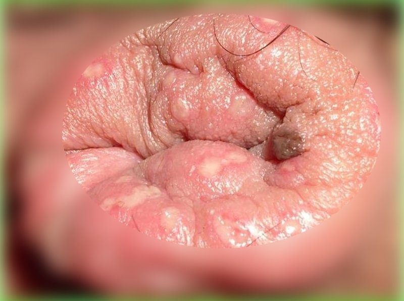 ヘルペス野田市 小児科 千葉県 こどもの花粉症 こどもの漢方 喘息 アトピー性皮膚炎 アレルギー 結節性痒疹 たんぽぽこどもクリニック