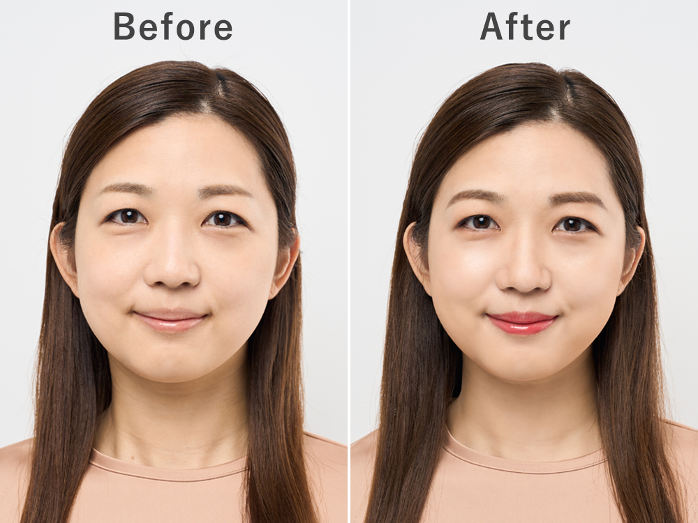 顔の余白を小さくする小顔整形を7つ紹介！顔やせや横幅・下部を短くする方法、大きくなる原因を解説アールビューティークリニック銀座・名古屋・大阪美容整形・美容外科・美容皮膚科