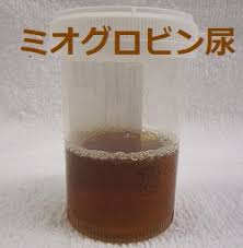 内科診療 : 尿蛋白の診断検査法と原因 :: 腎臓・泌尿器科専門病院 高山病院 福岡県筑紫野市