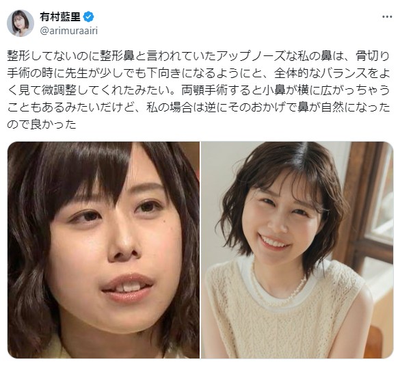 美人整形垢さんの公表されている整形レシピまとめてみた。 みんな顔フルだね。 🏥全国の技術専門医のご紹介やお得なクーポン特典&PR情報はプロフィールURLのメールフォームからお問い合わせください📩📞090-8435-3332 全切開鼻孔縁挙
