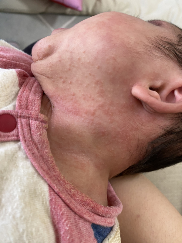 赤ちゃんの首のただれなのですが、毎日きちんと首のところを綺麗に洗って乾- Yahoo!知恵袋