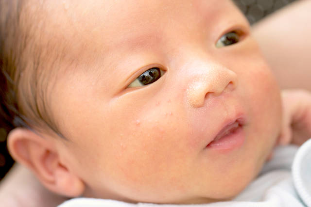 医師解説 新生児黄疸はいつ治る？原因・症状・自宅での対処法を解説