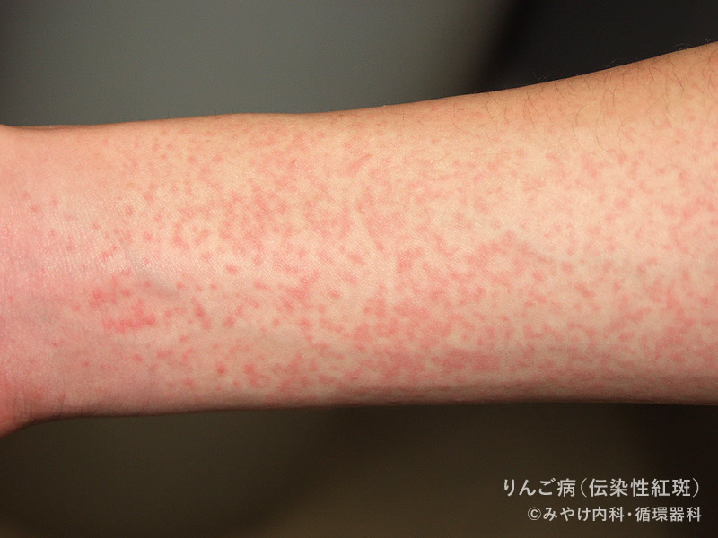 線状皮膚炎こばとも皮膚科栄駅 名古屋市栄区 徒歩2分