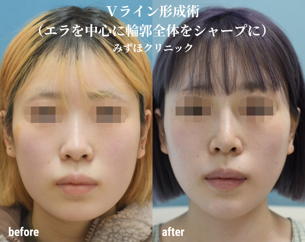 エラ張り、ベース顔で調べても全然ベース顔が気にならない画像ば- Yahoo!知恵袋