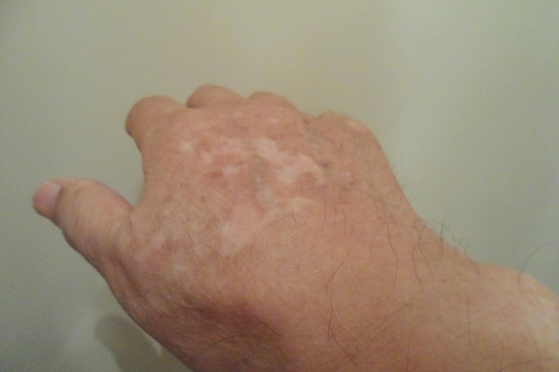 一般皮膚科：白斑 はくはん 平岡皮膚科スキンケアクリニック札幌市清田区