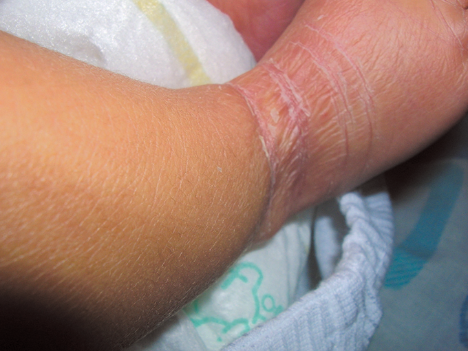 新生児の皮がむける「新生児落屑」って？赤ちゃんの体の特徴について 助産師監修公式 SOLIA SHOP