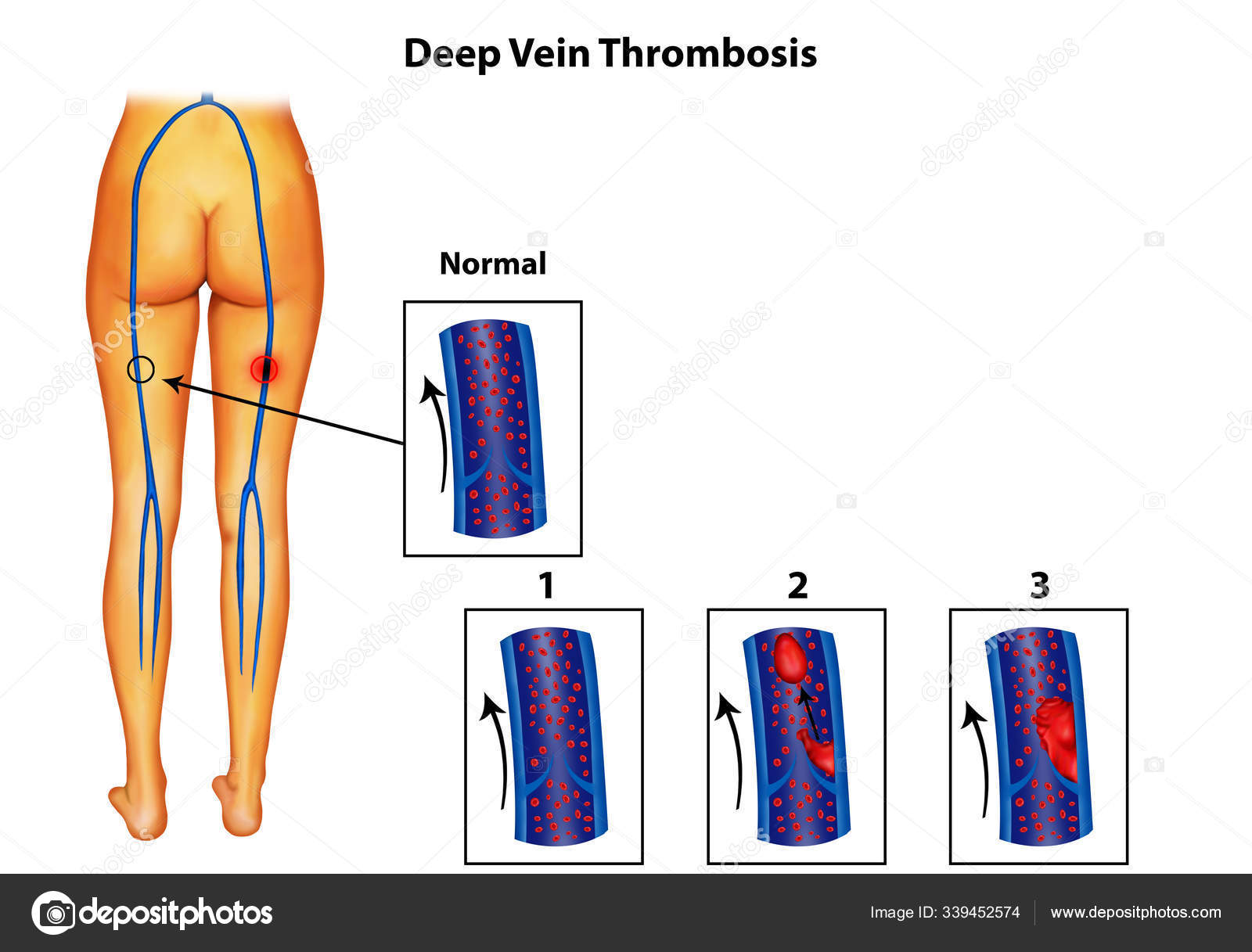 肺血栓塞栓症のベクター画像イラスト。血管血栓症」のベクター画像素材 ロイヤリティフリー737751463Shutterstock