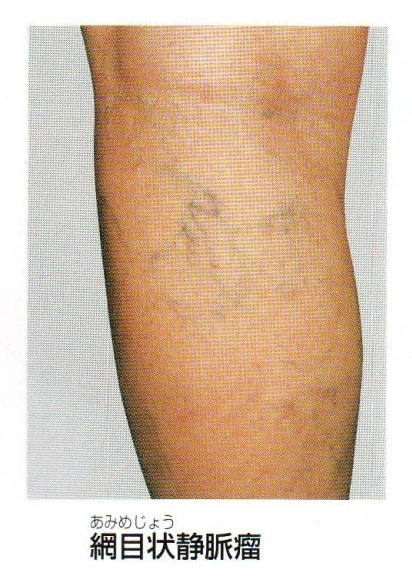 症例78「切断を回避できた糖尿病性壊疽」つかもと内科